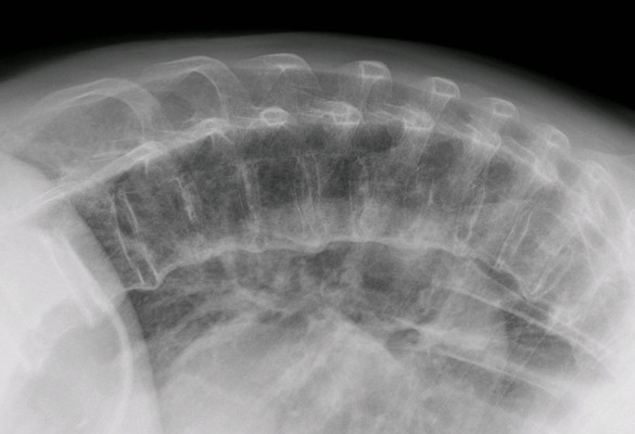 Small Molecules to Treat Skeletal Disorders Caused by Integrated Stress Response